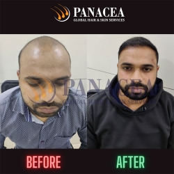 Bio FUE Hair Transplant Before and After Result in Delhi